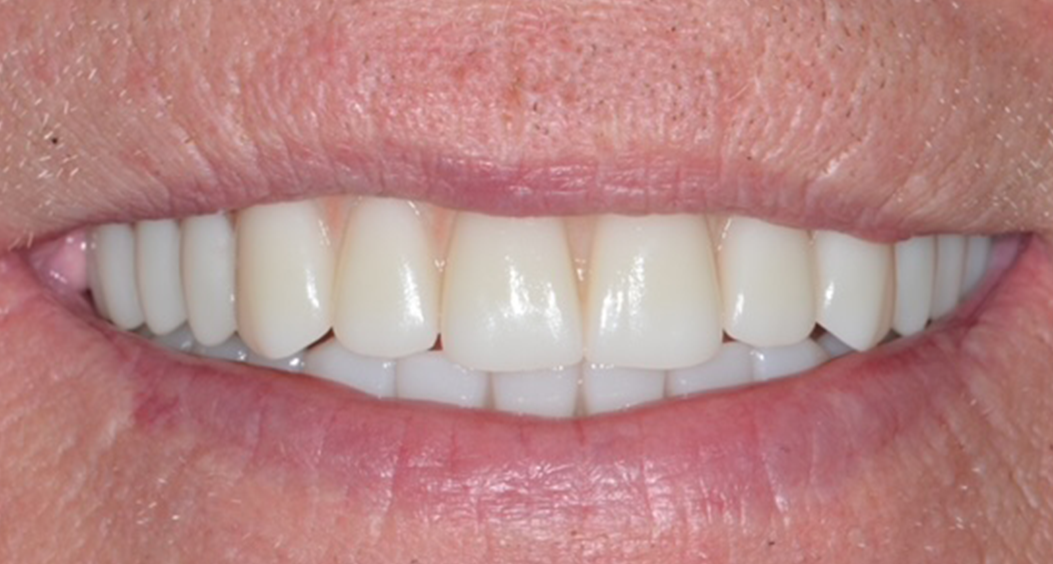 dental implants  portadown