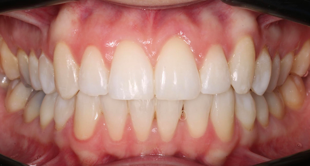 tooth whitening portadown