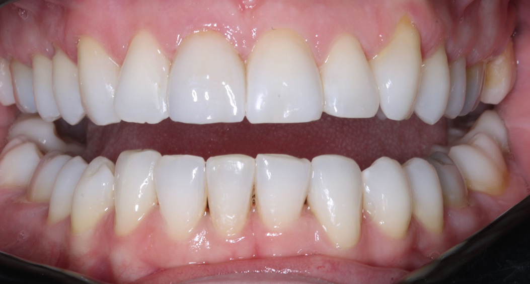 tooth whitening portadown