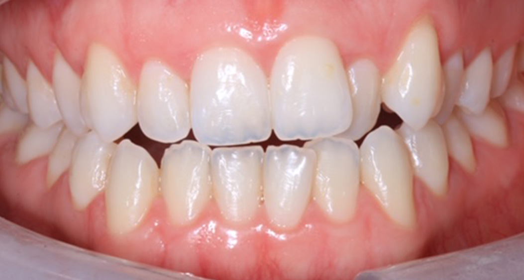 braces at william street dental