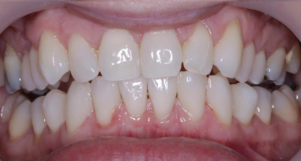 tooth whitening portadown