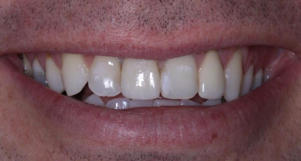 tooth whitening portadown