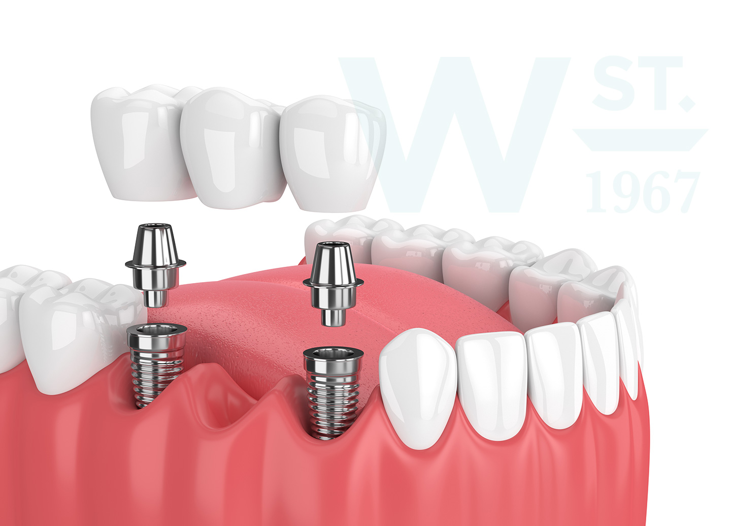 Implants in Portadown Dental Implants at William Street Dental Dentist in Portadown