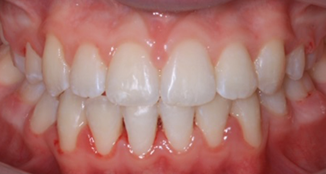 tooth whitening portadown