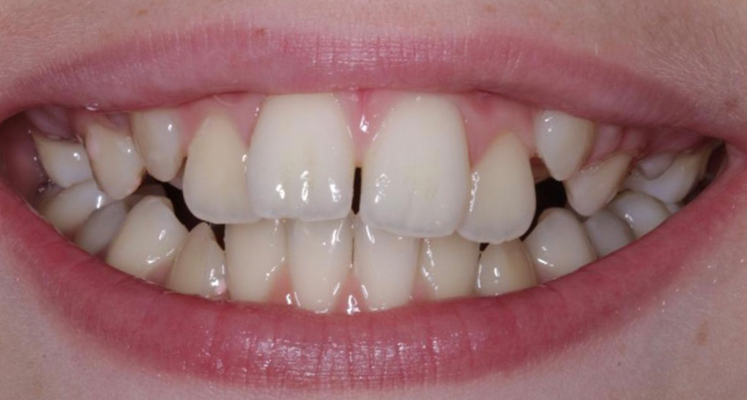 adult braces william street dental