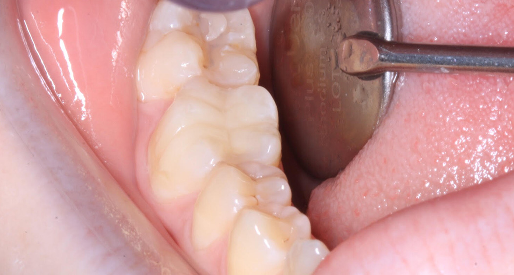 tooth whitening portadown