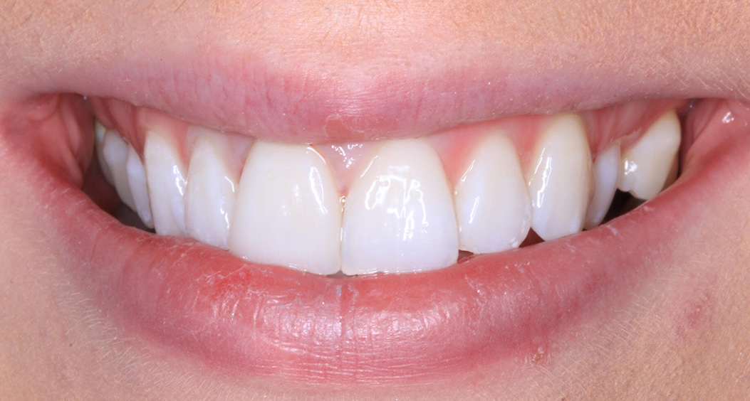 tooth whitening portadown