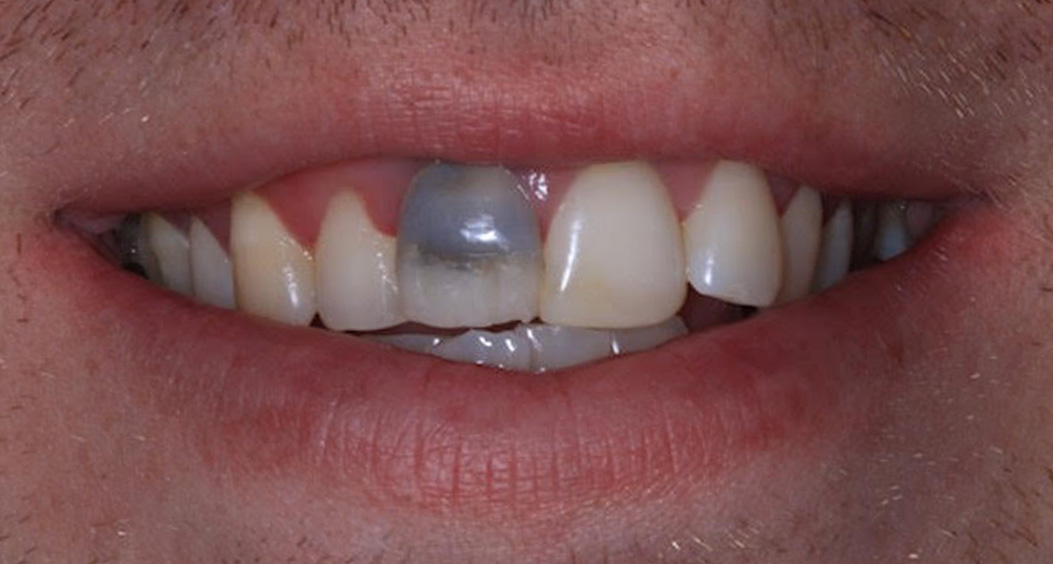 Tooth Whitening in Portadown - William Street Dental ...